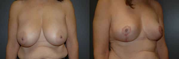 Breast Reduction before and after photo by Dr. Richard A. Bartlett in Brookline, MA