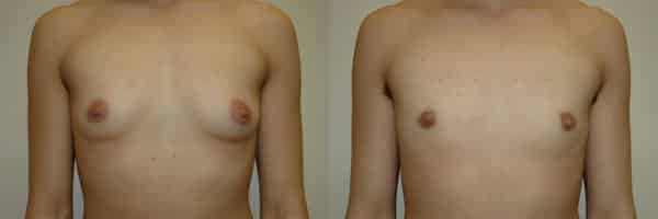 Gender Affirming Surgery before and after photo by Dr. Richard A. Bartlett in Brookline, MA