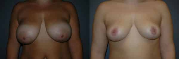 Breast Reduction before and after photo by Dr. Richard A. Bartlett in Brookline, MA