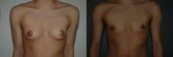 Gender Affirming Surgery before and after photo by Dr. Richard A. Bartlett in Brookline, MA