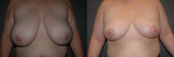Breast Reduction before and after photo by Dr. Richard A. Bartlett in Brookline, MA