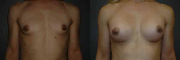 Gender Affirming Surgery before and after photo by Dr. Richard A. Bartlett in Brookline, MA