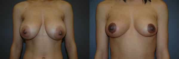Breast Reduction before and after photo by Dr. Richard A. Bartlett in Brookline, MA