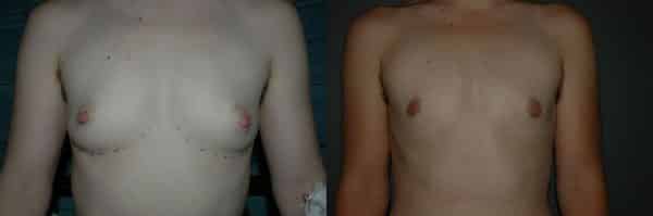 Gender Affirming Surgery before and after photo by Dr. Richard A. Bartlett in Brookline, MA