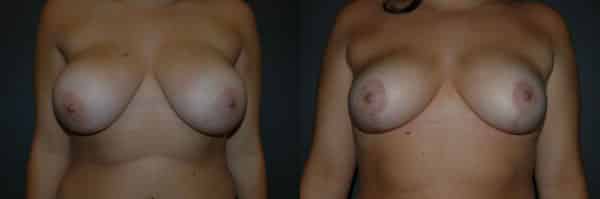 Breast Reduction before and after photo by Dr. Richard A. Bartlett in Brookline, MA