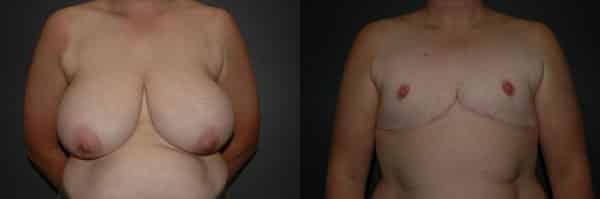 Gender Affirming Surgery before and after photo by Dr. Richard A. Bartlett in Brookline, MA