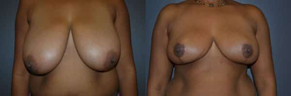 Breast Reduction before and after photo by Dr. Richard A. Bartlett in Brookline, MA