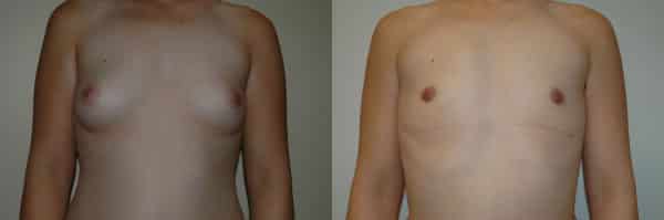 Gender Affirming Surgery before and after photo by Dr. Richard A. Bartlett in Brookline, MA