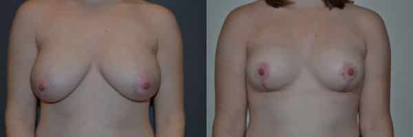 Breast Reduction before and after photo by Dr. Richard A. Bartlett in Brookline, MA