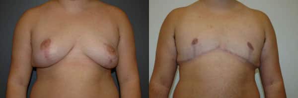 Gender Affirming Surgery before and after photo by Dr. Richard A. Bartlett in Brookline, MA