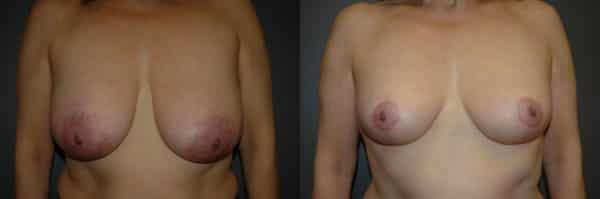 Breast Reduction before and after photo by Dr. Richard A. Bartlett in Brookline, MA