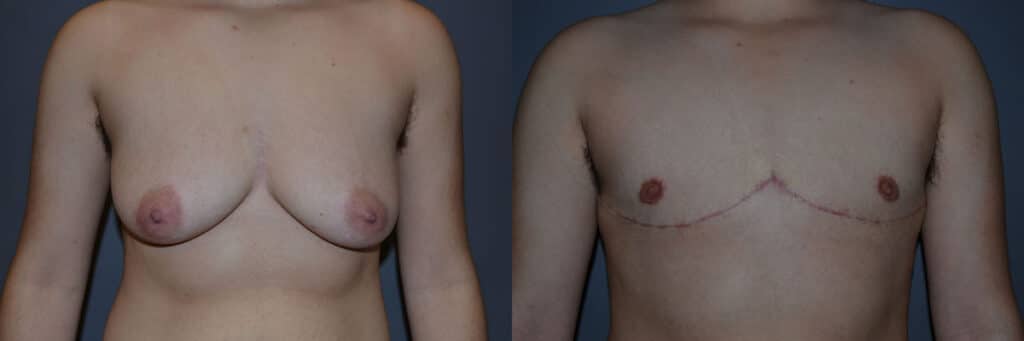 Gender Affirming Surgery before and after photo by Dr. Richard A. Bartlett in Brookline, MA