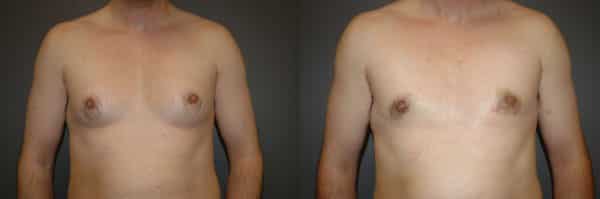 Gynecomastia (Male Breast Reduction) before and after photo by Dr. Richard A. Bartlett in Brookline, MA