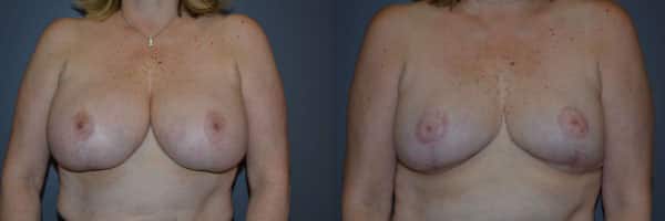 Breast Reduction before and after photo by Dr. Richard A. Bartlett in Brookline, MA
