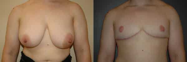 Gender Affirming Surgery before and after photo by Dr. Richard A. Bartlett in Brookline, MA