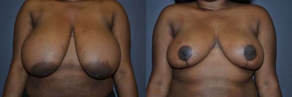 Breast Reduction before and after photo by Dr. Richard A. Bartlett in Brookline, MA