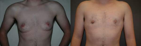Gender Affirming Surgery before and after photo by Dr. Richard A. Bartlett in Brookline, MA
