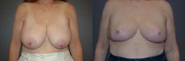 Breast Reduction before and after photo by Dr. Richard A. Bartlett in Brookline, MA