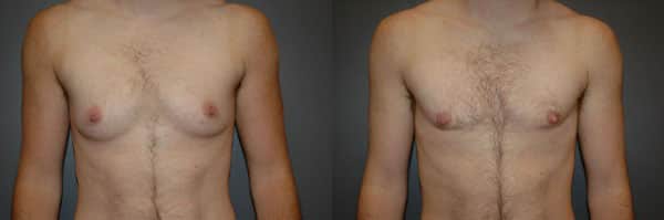 Gender Affirming Surgery before and after photo by Dr. Richard A. Bartlett in Brookline, MA