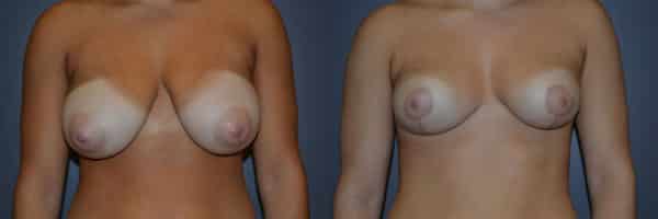 Breast Reduction before and after photo by Dr. Richard A. Bartlett in Brookline, MA