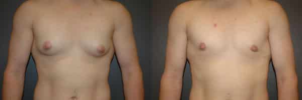 Gender Affirming Surgery before and after photo by Dr. Richard A. Bartlett in Brookline, MA