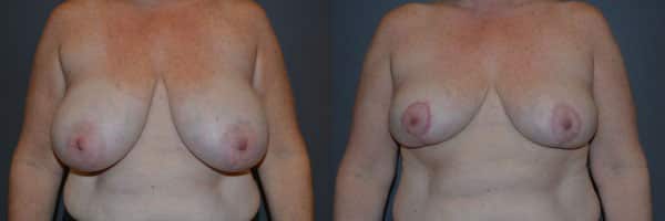 Breast Reduction before and after photo by Dr. Richard A. Bartlett in Brookline, MA