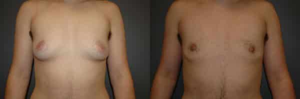Gender Affirming Surgery before and after photo by Dr. Richard A. Bartlett in Brookline, MA