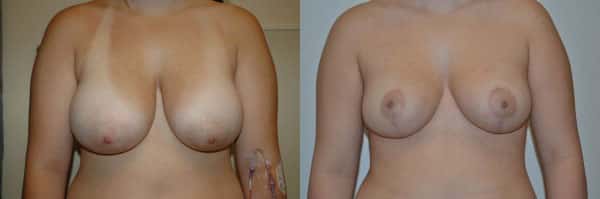 Breast Reduction before and after photo by Dr. Richard A. Bartlett in Brookline, MA