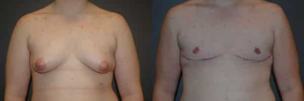 Gender Affirming Surgery before and after photo by Dr. Richard A. Bartlett in Brookline, MA