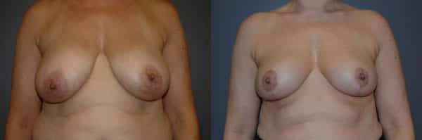 Breast Reduction before and after photo by Dr. Richard A. Bartlett in Brookline, MA