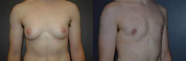 Gender Affirming Surgery before and after photo by Dr. Richard A. Bartlett in Brookline, MA