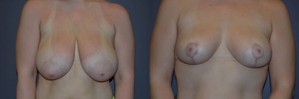 Breast Reduction before and after photo by Dr. Richard A. Bartlett in Brookline, MA