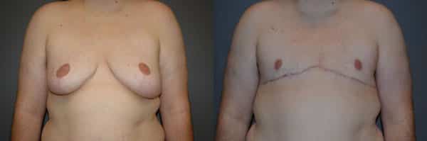 Gender Affirming Surgery before and after photo by Dr. Richard A. Bartlett in Brookline, MA