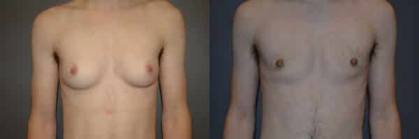 Gender Affirming Surgery before and after photo by Dr. Richard A. Bartlett in Brookline, MA