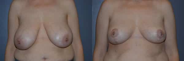Breast Reduction before and after photo by Dr. Richard A. Bartlett in Brookline, MA