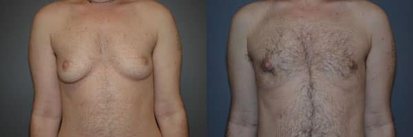 Gender Affirming Surgery before and after photo by Dr. Richard A. Bartlett in Brookline, MA