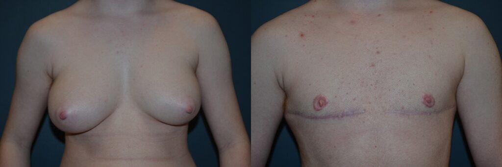 Gender Affirming Surgery before and after photo by Dr. Richard A. Bartlett in Brookline MA
