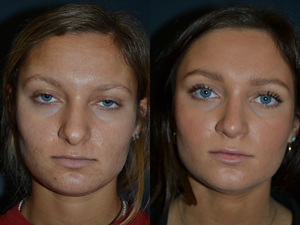 Rhinoplasty (Nose Surgery) before and after photo by Dr. Richard A. Bartlett in Brookline, MA
