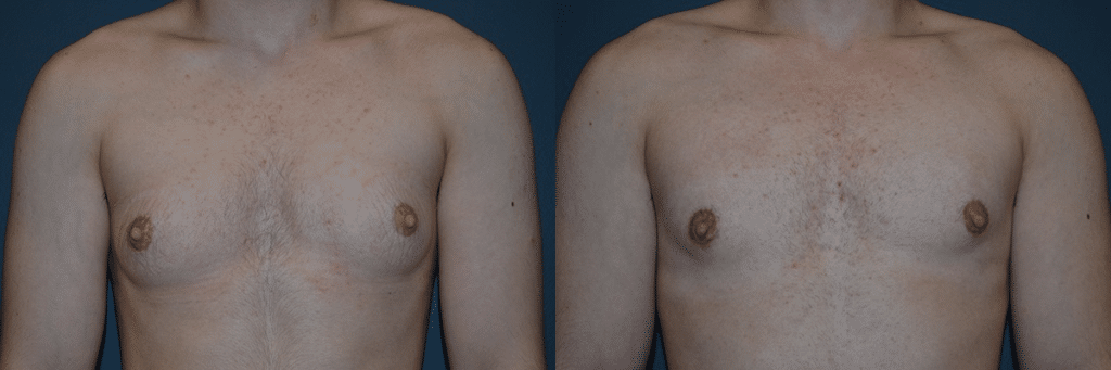 Gender Affirming Surgery before and after photo by Dr. Richard A. Bartlett in Brookline MA