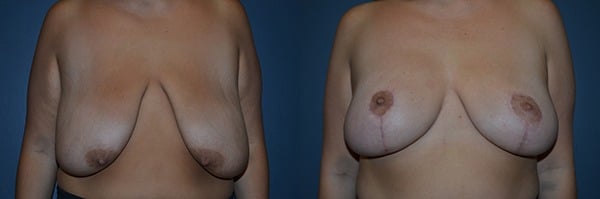 Breast Reduction before and after photo by Dr. Richard A. Bartlett in Brookline, MA