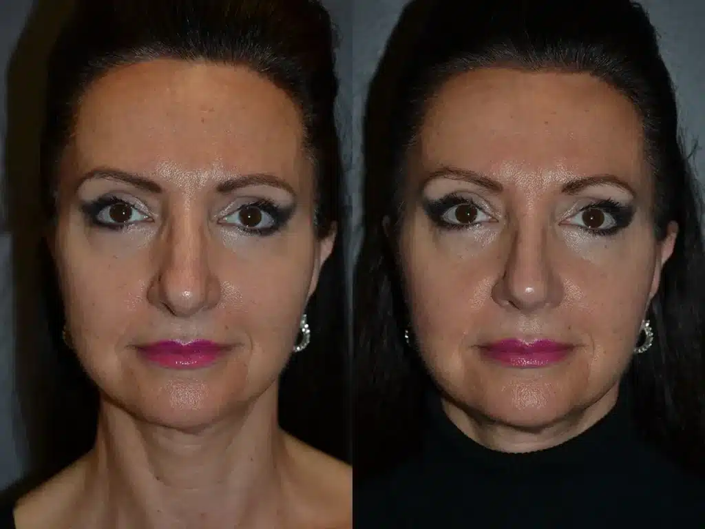 Front View Rhinoplasty before and after photo by Dr. Bartlett