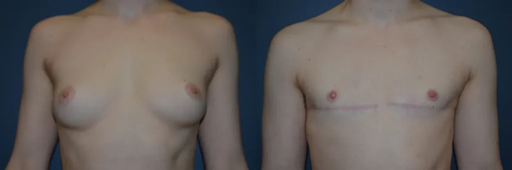 Front View Double Incision Surgery before and after photoby Dr. Bartlett