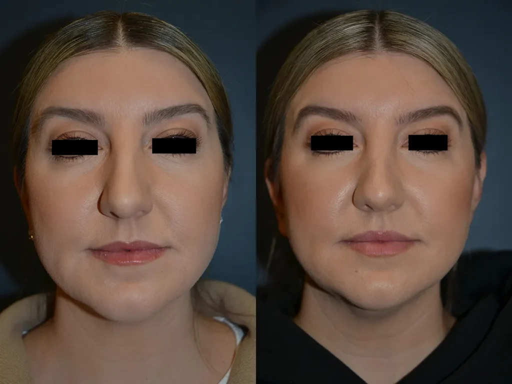 Front View Rhinoplasty before and after photo by Dr. Bartlett