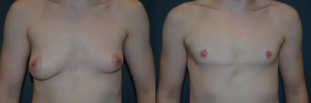 Front View Double incision top surgery before and after photo by Dr. Bartlett
