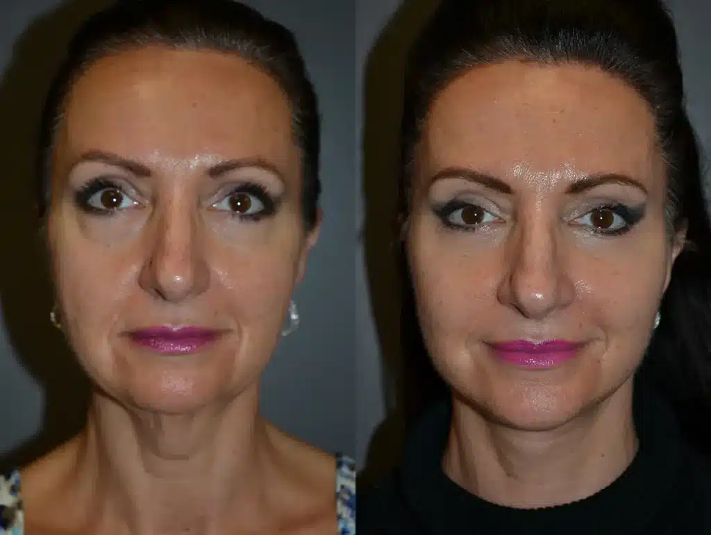 Front View Facelift before and after photo by Dr. Bartlett