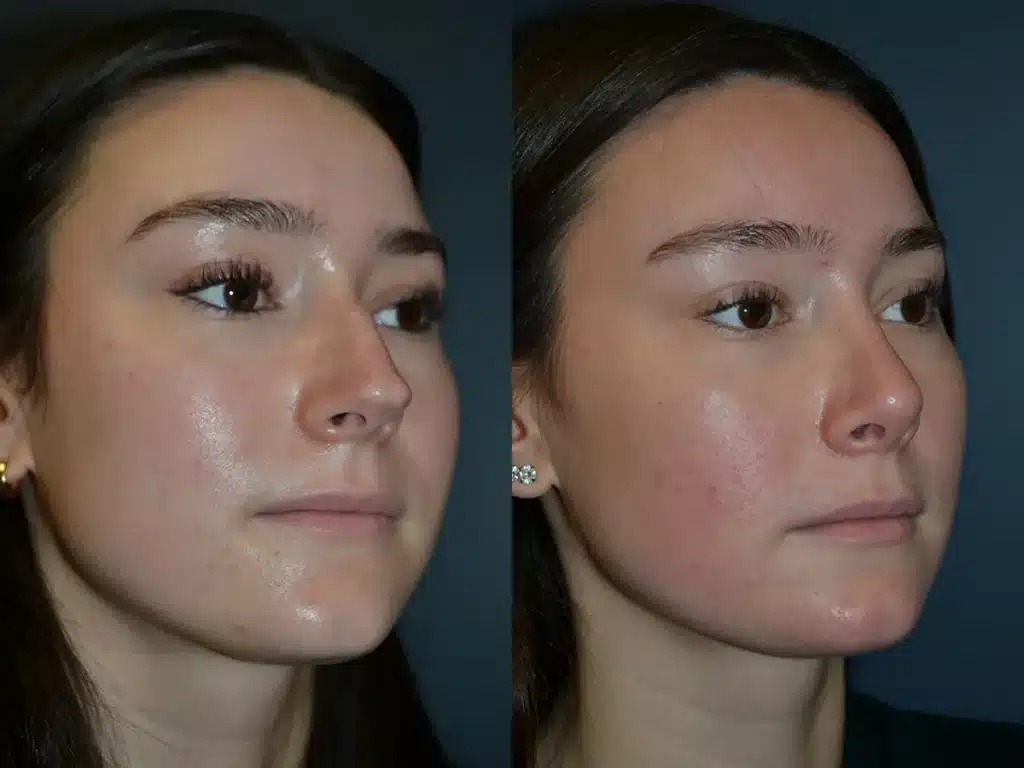 Right Oblique View Open Rhinoplasty before and after photo by Dr. Bartlett